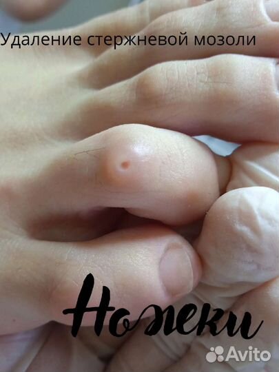 Лечебный педикюр