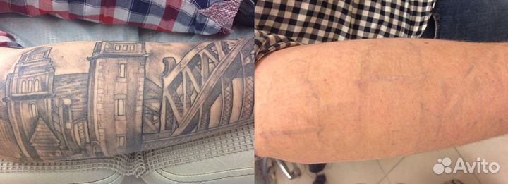 Лазерное удаление тату и татуажа