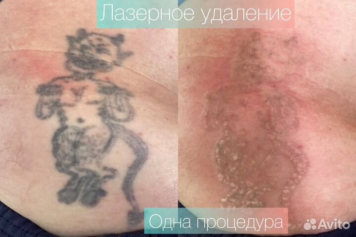 Удаление/осветление тату и татуажа лазером