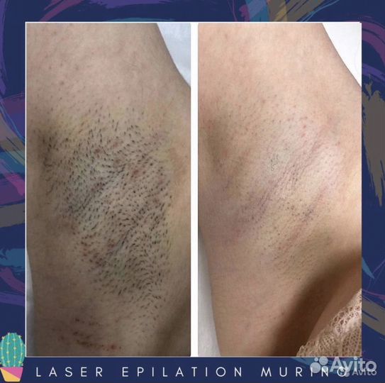 Лазерная эпиляция метро Девяткино