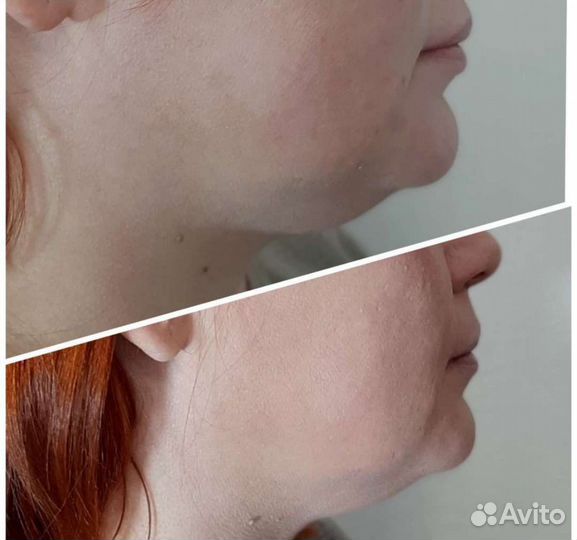 СМАС лифтинг