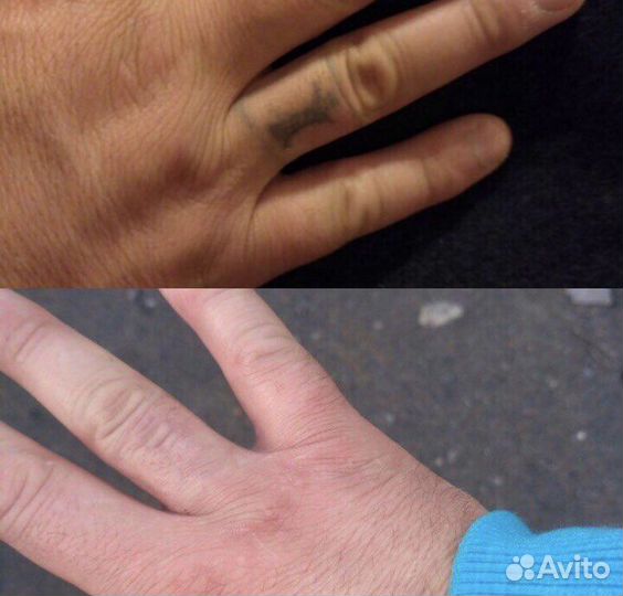 Удаление тату