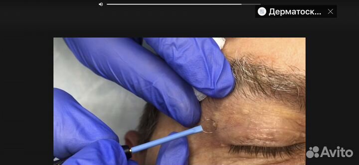 Электрокаогуляция новообразований на лице и теле