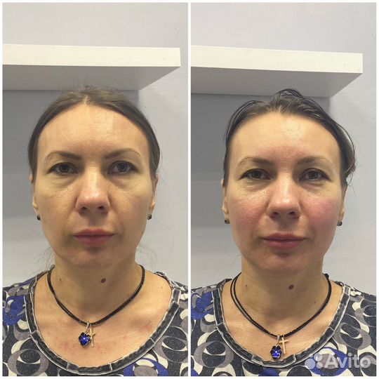 Массаж лица (разные техники)