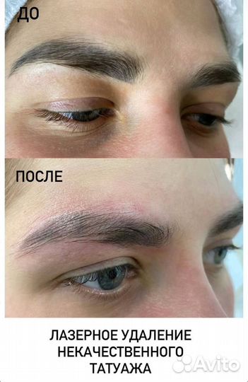 Модели на удаление тату и некачественного татуажа