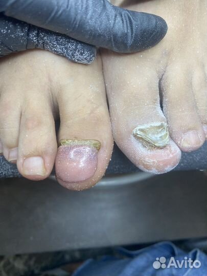 Педикюр, сложные случаи, пластины на ногти