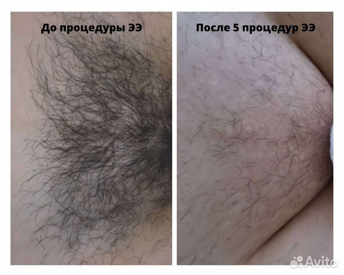Электроэпиляция