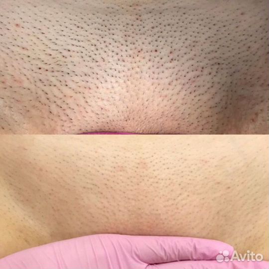 Лазерная эпиляция: глубокое бикини