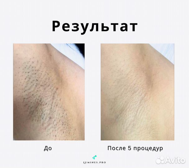 Диодный лазер для эпиляции «Lumines» MaxOne 1200вт