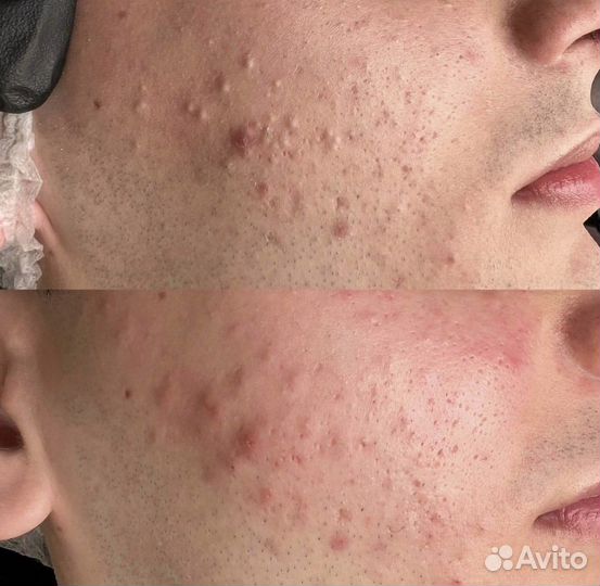 Косметолог чистка лица