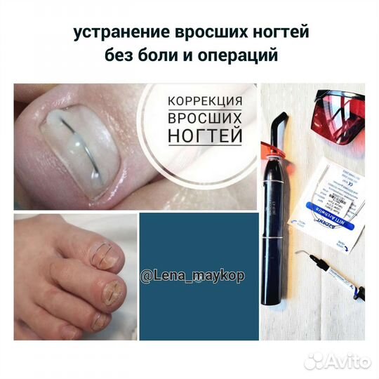 Установка титановой нити, установка тампонады