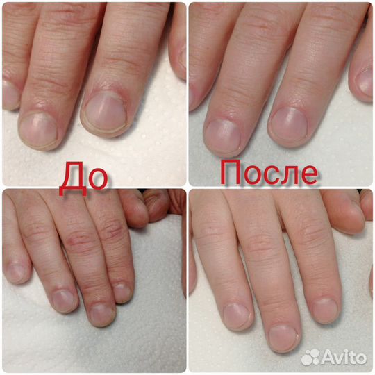 Лечебный педикюр