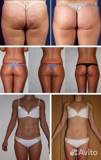 Антицеллюлитный массаж