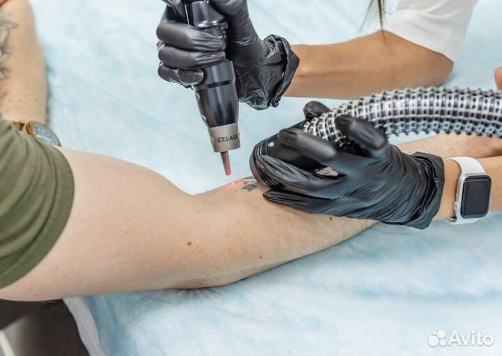 Удаление татуировок и татуажа в Москве