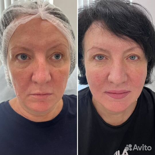 Подтяжка лица эффект с 1 процедуры