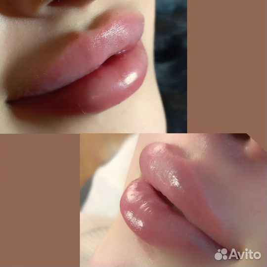 Увеличение губ