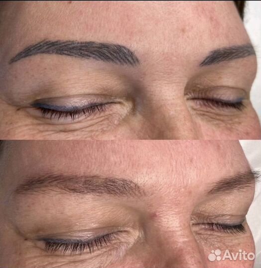 Лазерное удаление тату