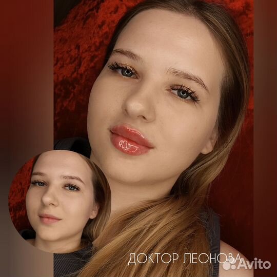 Увеличение губ у врача