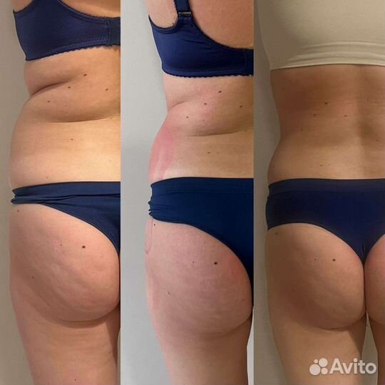 Субдермальный вибрационный массаж