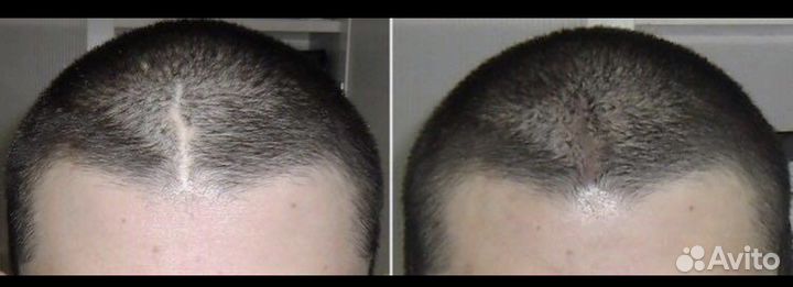 Трихопигментация