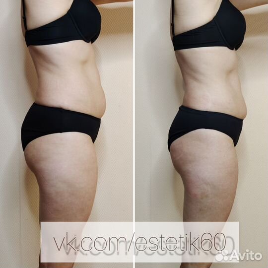 Антицеллюлитный массаж