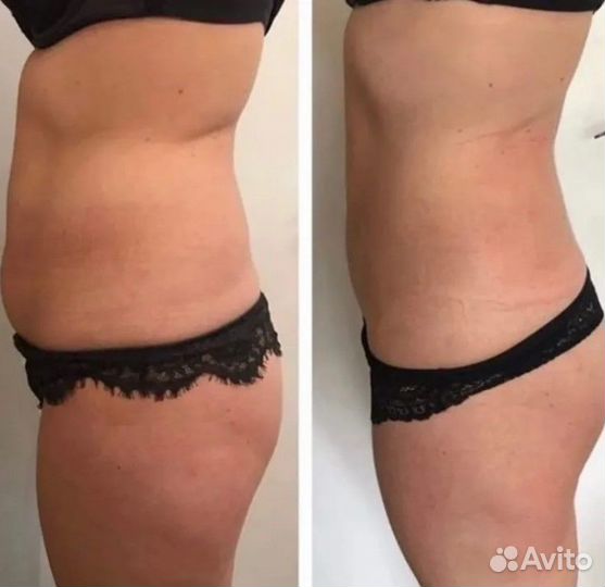 Услуги кавитации/Кавитация