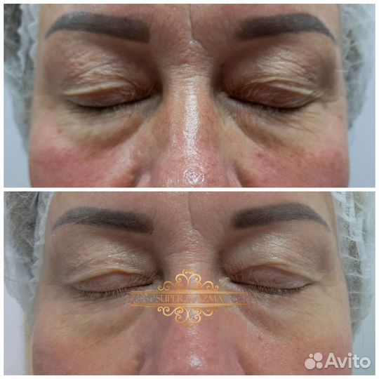 Процедуры холодной плазмы