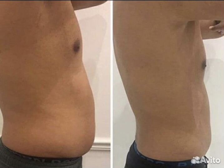 Криолиполиз для мужчин на новейшем аппарате