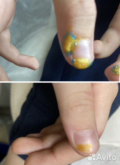 Удаление бородавок