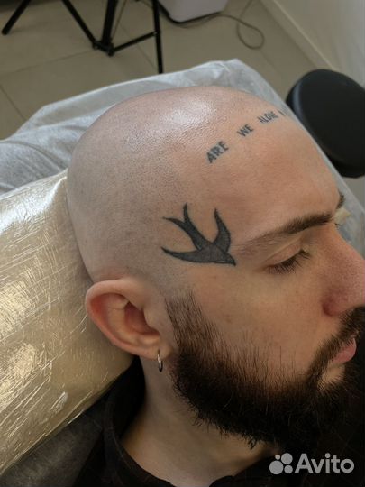 Трихопигментация головы, метод SMP