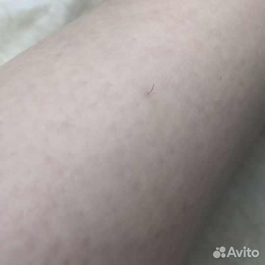 Электроэпиляция