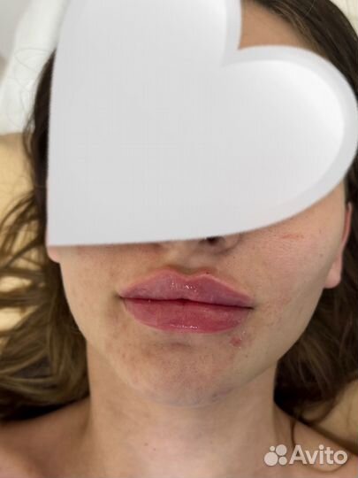 Контурная пластика лица