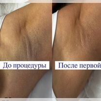Лазерная эпиляция на Ломоносовской ЖК Стрижи, Санкт-Петербург