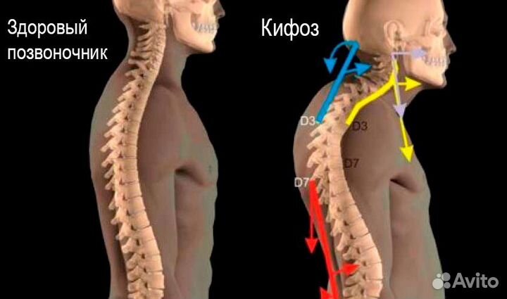 Выпрямление позвоночника