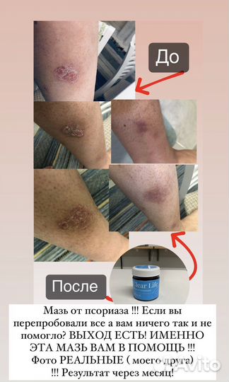 Мазь от псориаза