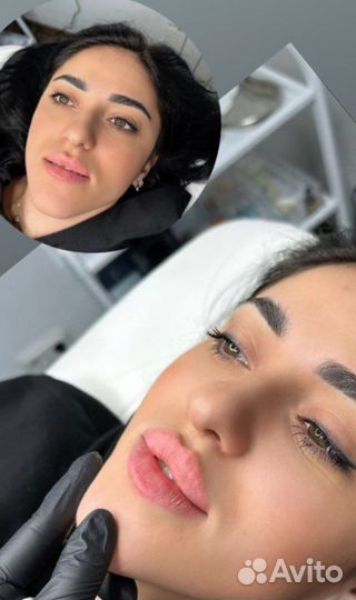 Аугментация губ, BioRepeelcl3, липолитик