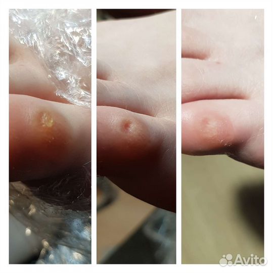 Подолог. Педикюр.лечебный педикюр. Сложные стопы