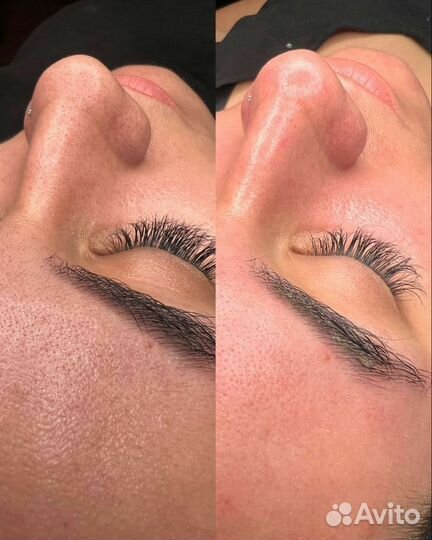 Ультразвуковая чистка лица