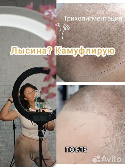 Трихопигментация головы коррекция облысения. Курсы