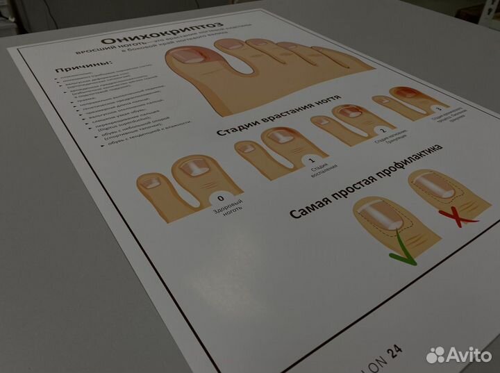 Плакат онихокриптоз
