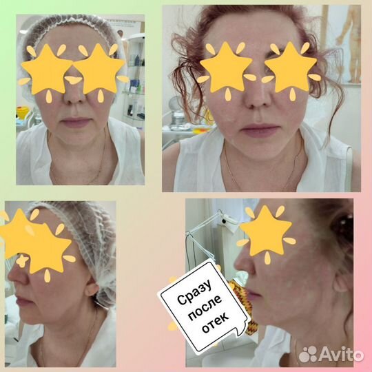 Увеличение губ Косметолог Нити Ког Акне Ботокс