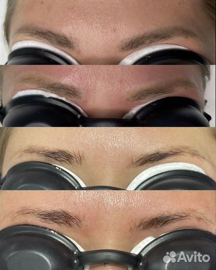 Удаление татуажа и тату лазером и ремувером