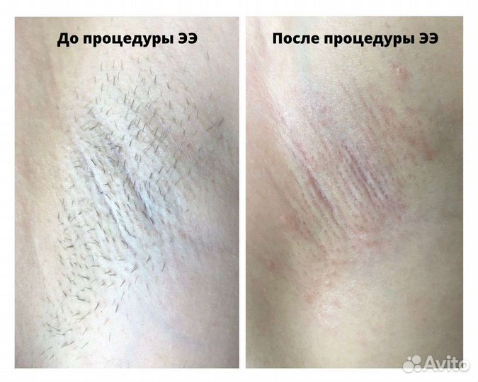Электроэпиляция