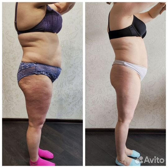 Антицеллюлитный вакуумный LPG массаж