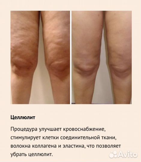 Аппарат коррекции фигуры