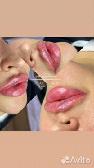 Увеличение губ, увлажнение 0,5мл, 1мл