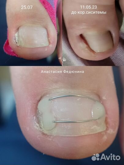 Подолог, Педикюр, SMART, Медицинский педикюр