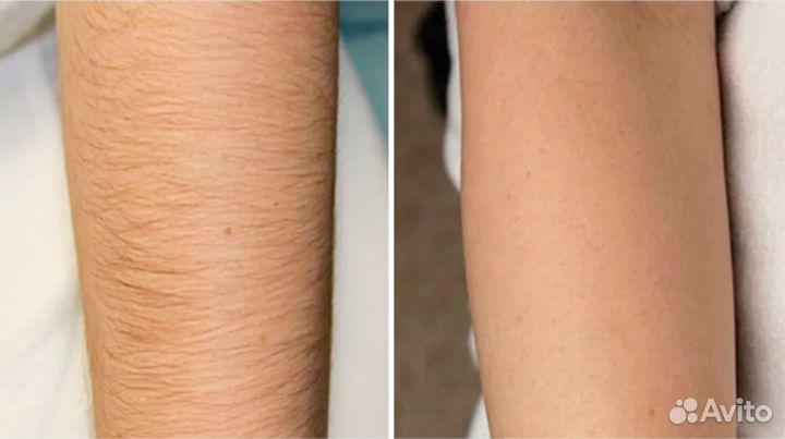 Модели / лазерная эпиляция / депиляция