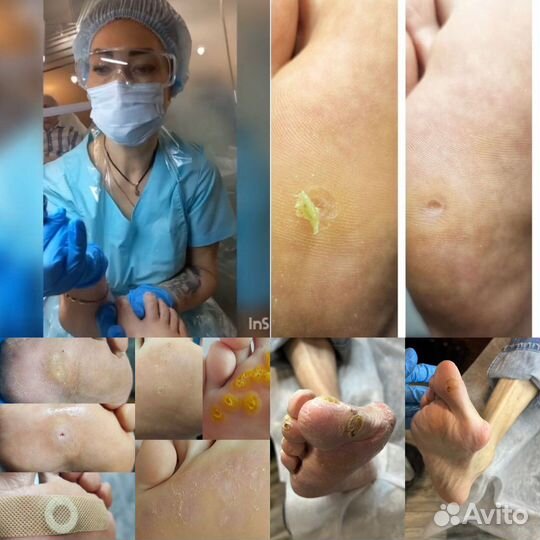 Услуги подолога- коррекция вросших ногтей