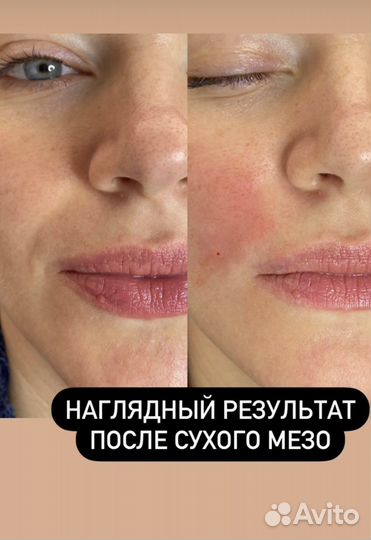 Мезотерапия лица